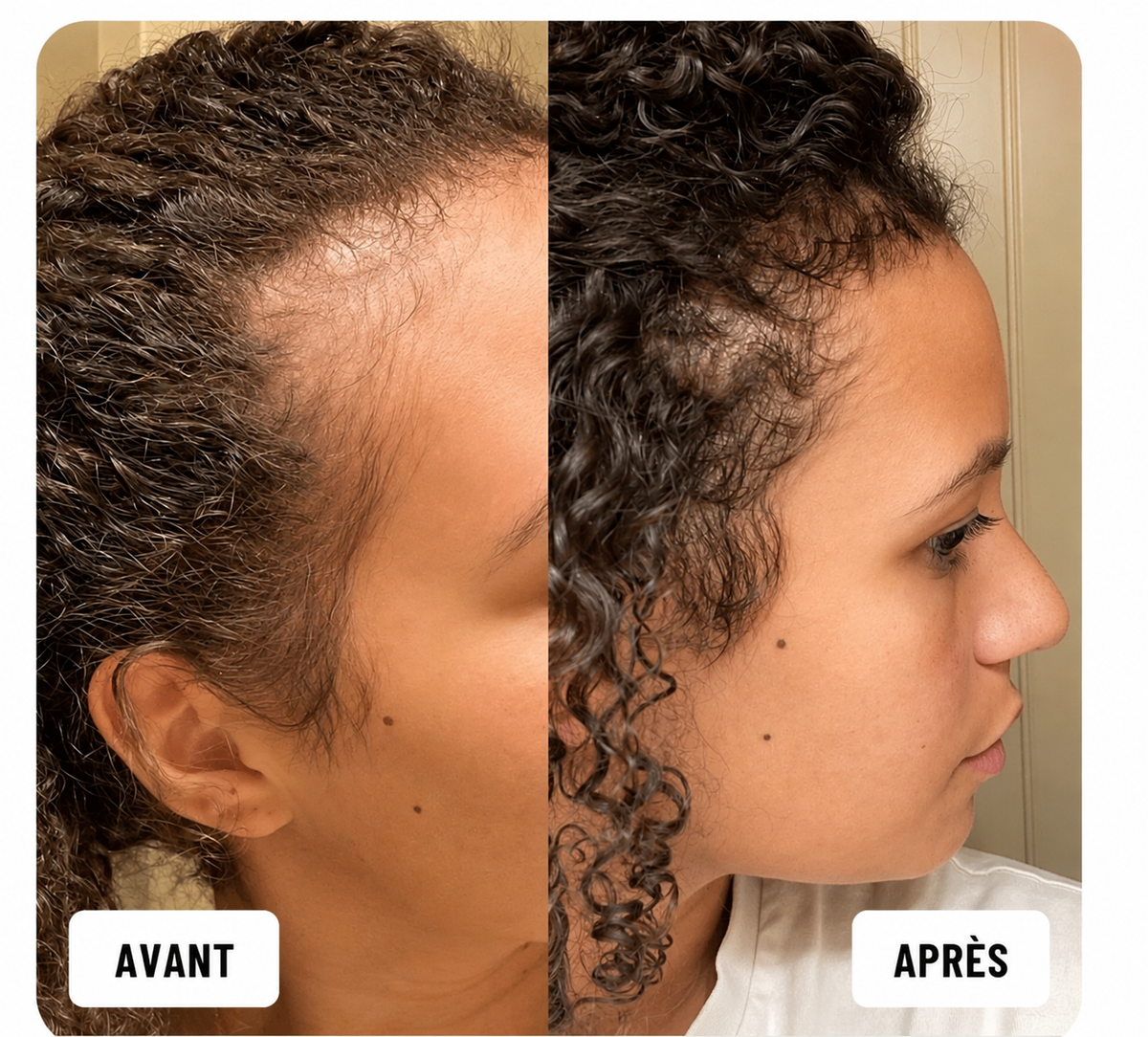 Serum roll on tempes,  dégarnies cuir chevelu